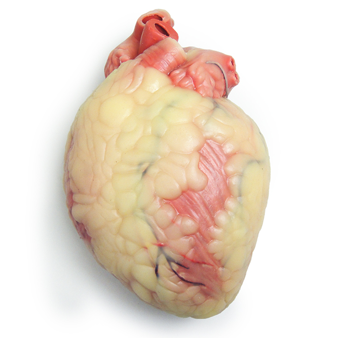 Ischemic (Enlarged) Heart (#1032)