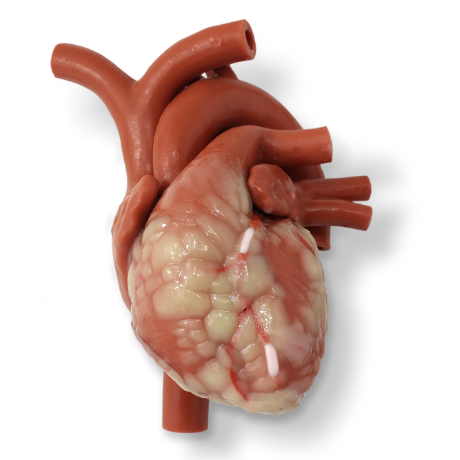 MICS Mitral CABG Beating Heart with Ancillary (#1413)