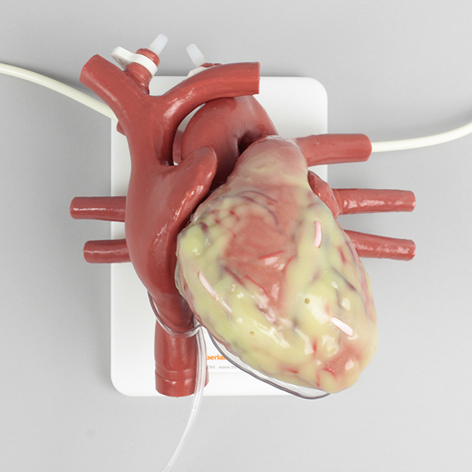 ECMO Beating Heart (#1519)